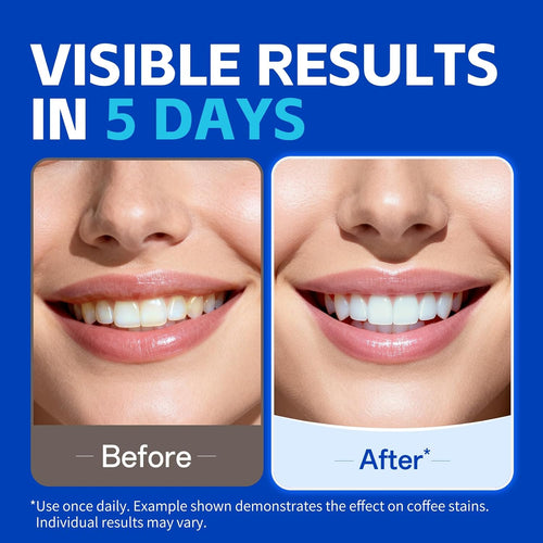 Teeth Whitening Strips – Professional Dentist Approved, Gum-Safe Formula, 14 Treatment, 28 Non-Slip Strips, Pain-Free Express Whitening Kit in 30 Min, Easy to Use for Bright Smile